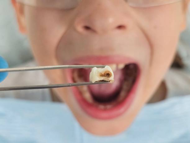 Best Emergency Tooth Extraction in Shell Kno, MO
